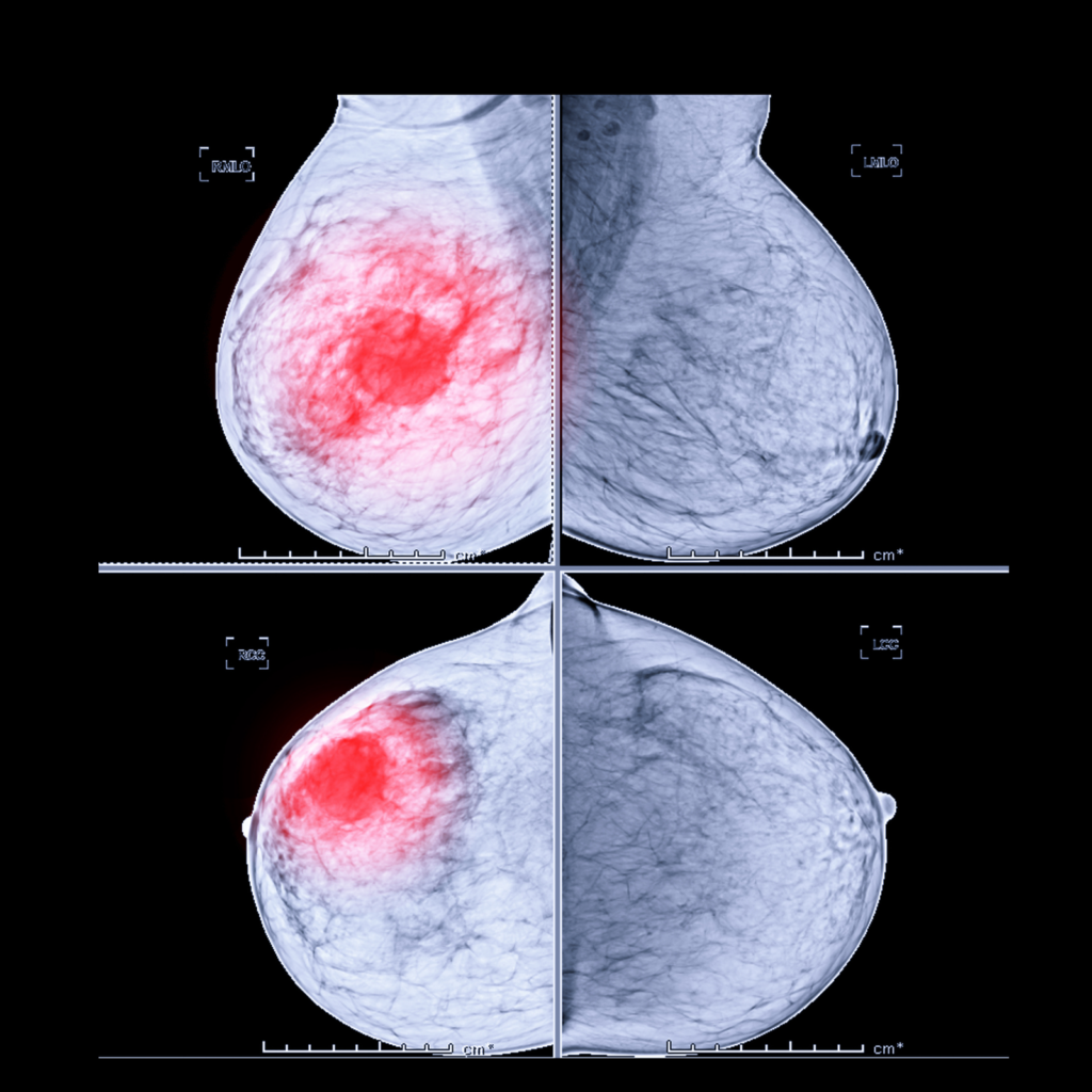 Diagnostic Digital Mammography