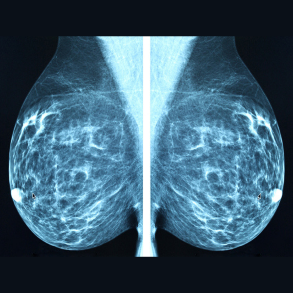 Interpreting the Mammography Report