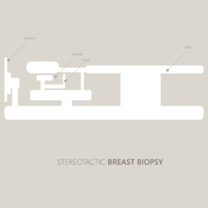 Stereotactic Breast Biopsy
